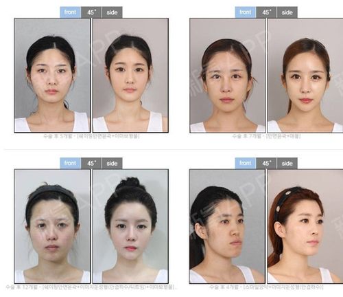 有没有朋友做过推颧骨 想问下和磨有什么区别么 是永久的么