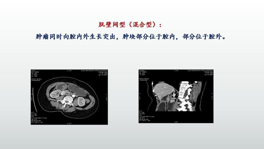 恶性者,肿瘤多大于6cm,境界欠清晰,与邻近组织
