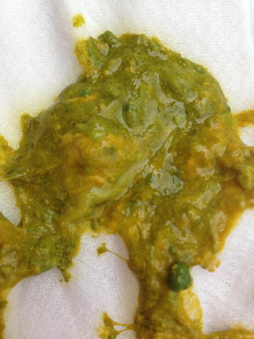 宝宝55天,轮状病毒感染,今天上午突然拉这样的大便,之前也发绿,但是没