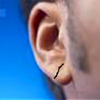 在耳朵耳垂部位有一道斜纹