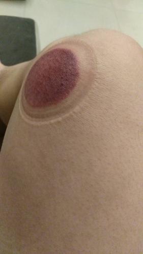 腿上拔罐这么红是什么情况