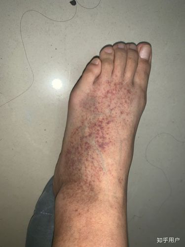 最开始的时候是初二,单纯的发现脚上长紫癜,大概长这样(做好准备)