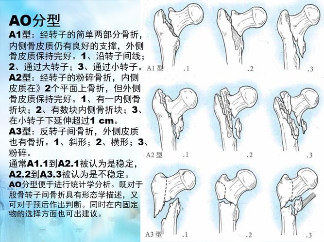 股骨转子间骨折(股骨粗隆间骨折)