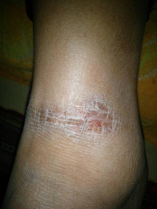 请问,脚脖子上长的像癣的一块硬皮,三年了,痒,挠挠会疼,请问大夫这是