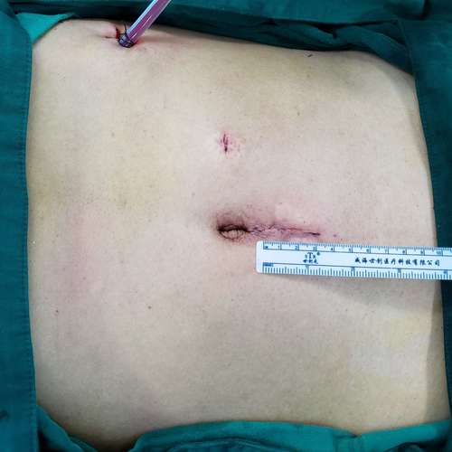 减孔完全腹腔镜下远端胃癌根治胃-空肠roux-y吻合术