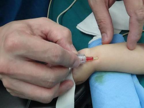 小儿插管与动静脉穿刺