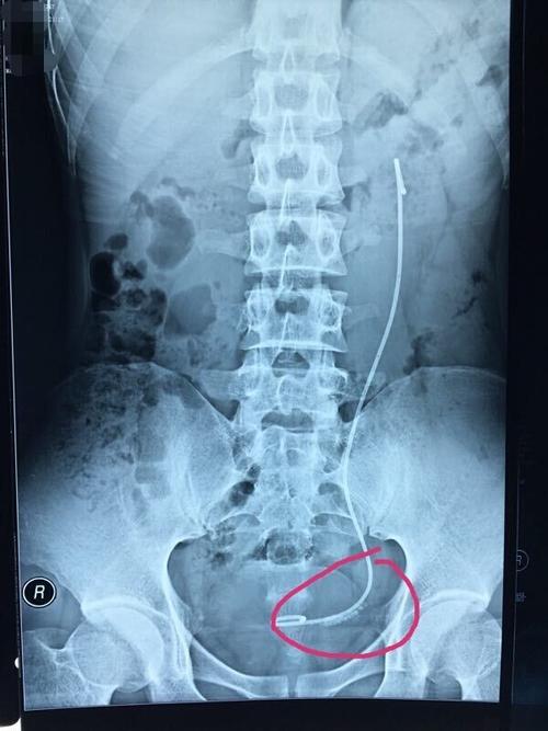 患者术后两周后复查腹部平片,可以清楚的看到结石碎末已经排到了输尿