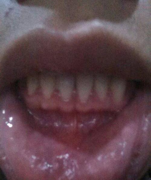 牙龈正常吗