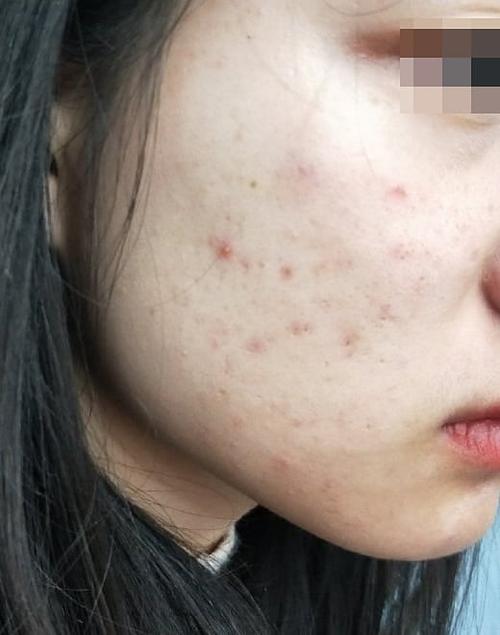 脸上长毛囊炎