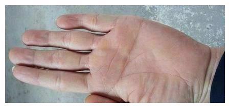 感情线和智慧线合二为一,横贯于手掌中即为断掌.