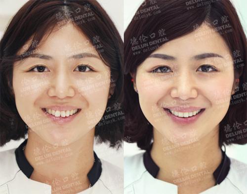 门牙过大,牙齿不齐修复:"兔女郎"的美牙蜕变