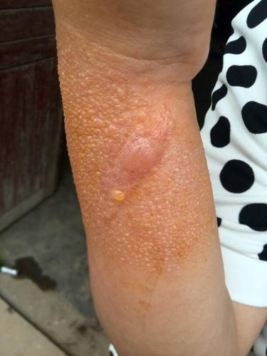 问:本来是手腕扭伤了,贴了医生给的膏药后就成这样了.怎么本?急!