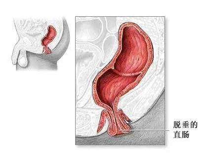 肛门口有肿物脱出是痔疮还是直肠脱垂