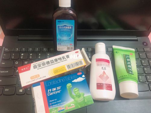 头皮痒,脂溢性皮炎怎么治疗?用什么药?