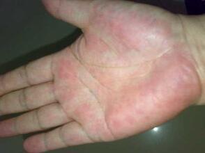 "蜘蛛痣""肝掌"什么鬼?是肝硬化吗?