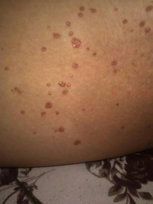 大腿内侧长的小豆豆,以前自己买过皮炎平过敏还长多了,后来在医院拿药