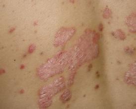 斑状红斑与白斑有何区别?