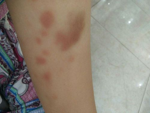 身上有很多淤青,这个颜色正常吗?