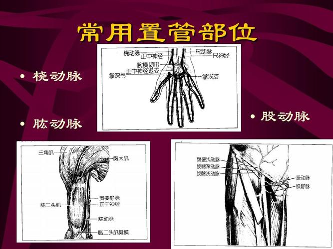 护理动脉置管ppt