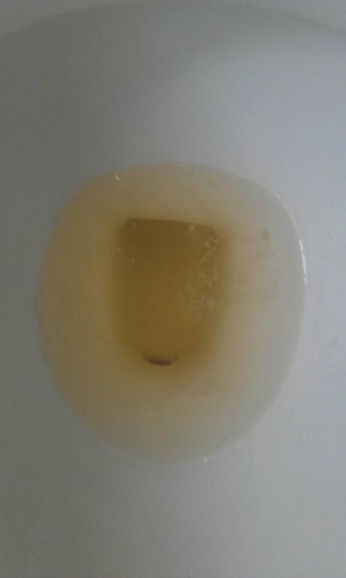 尿液有很多泡泡,一段时间后大部分消失,但仍有部分,同时有白色漂浮物.