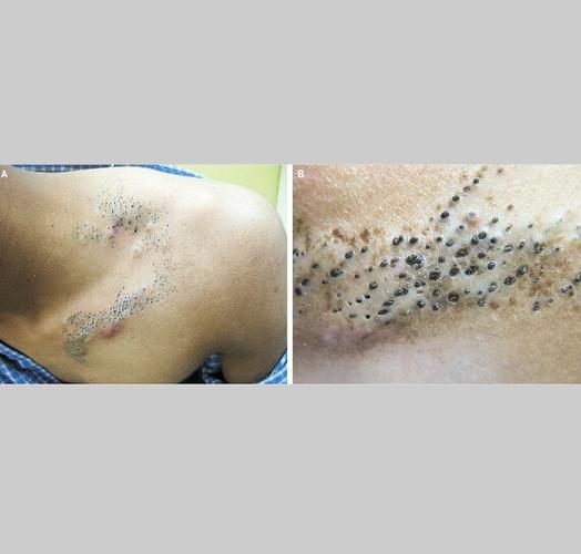 先天性皮肤病变(见图a),伴排列紧密的扩张的带角质栓的毛囊皮脂腺开口