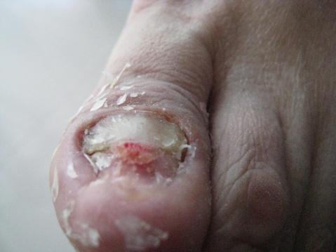 这时,我庆幸自己没有采用麻醉拔甲,因为如果采用