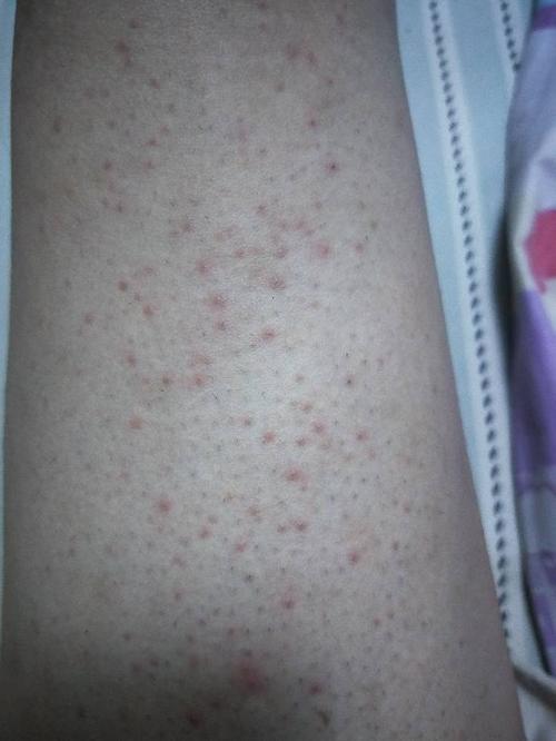 第一天刮了腿毛之后,第二天晚上回家发现腿上长了好多红点是怎么回事