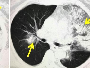 h7n9型禽流感肺部感染,单纯靠x线或ct能确诊吗?