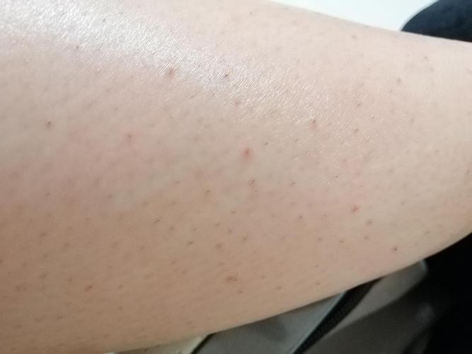 这种毛囊炎或者鸡皮肤有办法去除吗?