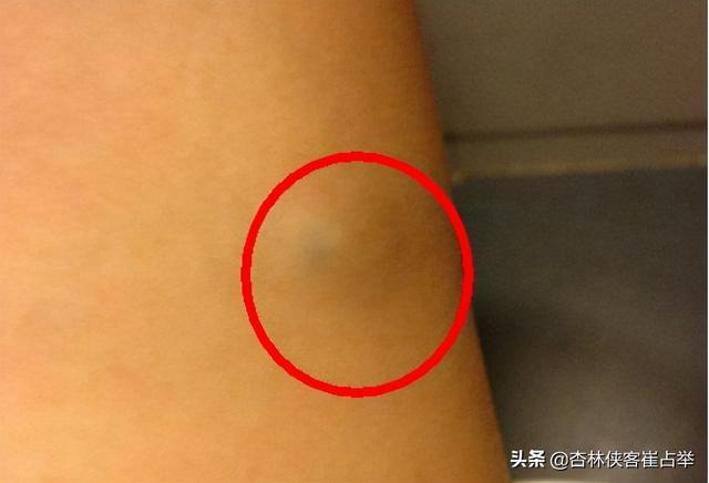 身上有脂肪瘤怎么办?医生告诉你不要担心,用这两味药可以消掉