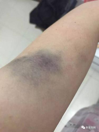 死者生前被打淤青照片流出.淮安26岁妈妈携儿喝农药