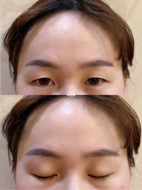 全切 开内眼角 提拉眼皮_内眼角_全切_双眼皮手术_大姨妈_淡妆_全切双