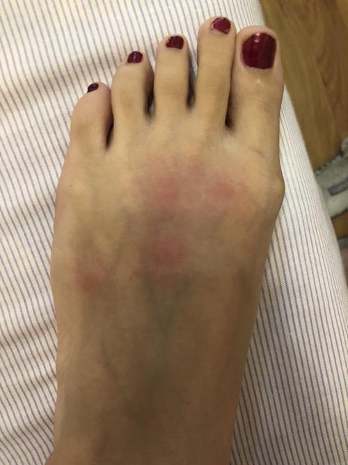 这是湿疹吗本来以为是被虫咬 只有脚上有 后来背上也长 现在胸前也有