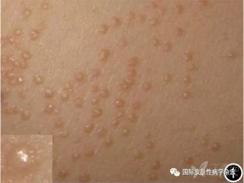 患者于8年前无明显诱因右下腹部皮肤出现粟粒大小丘疹,随后皮损范围