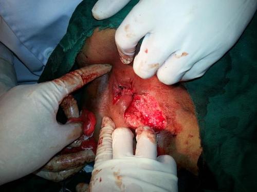 肛瘘,混合痔术前及术后一天图片