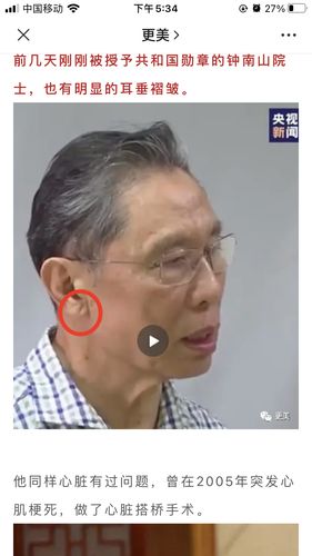 耳垂皱褶,俞老师的演员也许要多多注意心脏问题