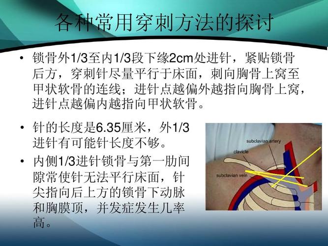 锁骨下静脉穿刺ppt