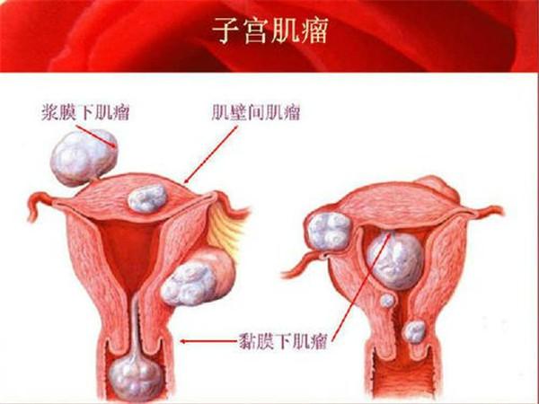 2,子宫下段,宫颈部位的较大肌瘤往往导致子宫发育不良,或者宫腔被肌瘤