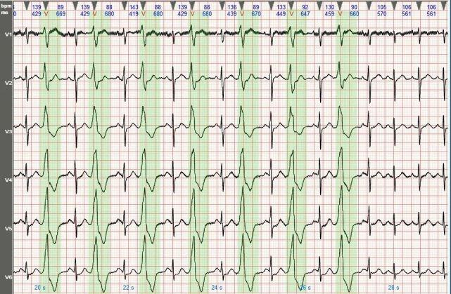 心电图图例分析3室性早搏呈二联律