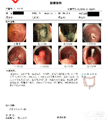 患者常规胃肠镜体检,直乙交接可见2枚亚蒂息肉隆起,靠近口侧大小