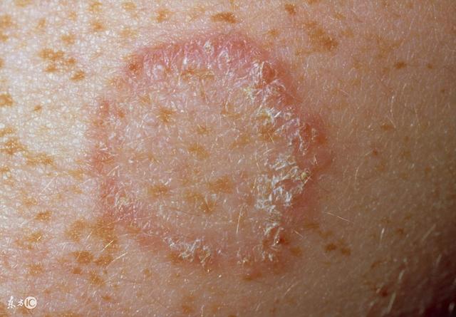 花斑癣也可以称之为花斑糠疹或是汗斑.