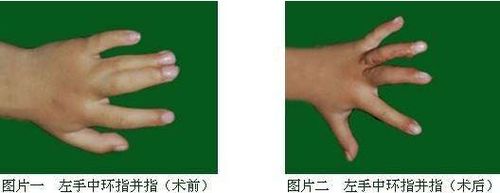 在皮肤及皮下组织严重不足的情况下,可在分指切开后,在指侧及指蹼创面