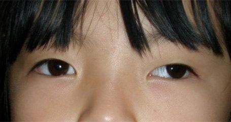 孩子得了间歇性外斜视该不该做手术