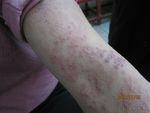 带状疱疹(过腰蛇)