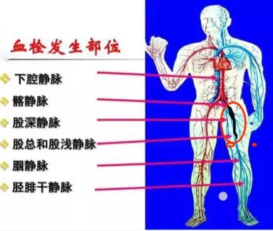 静脉曲张和肺栓塞有必然联系吗用这个护理方法清除早期血栓