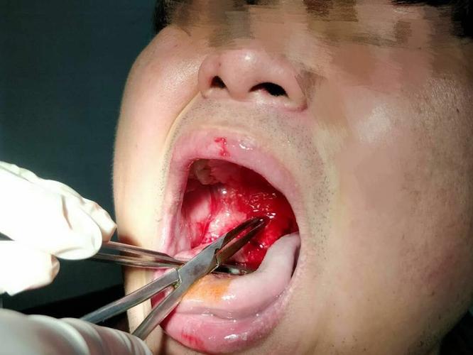 扁桃体周围脓肿切开扩张引流的手术治疗