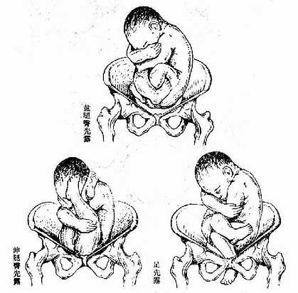 邻近器官 第一节 骨盆的组成 第二节 骨盆腔        图24 臀位,均为骶