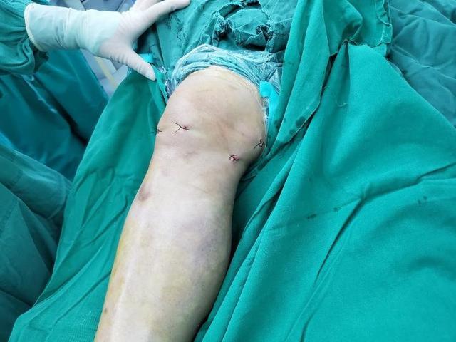 寿光市人民医院关节镜治疗腘窝囊肿——不开刀切除大