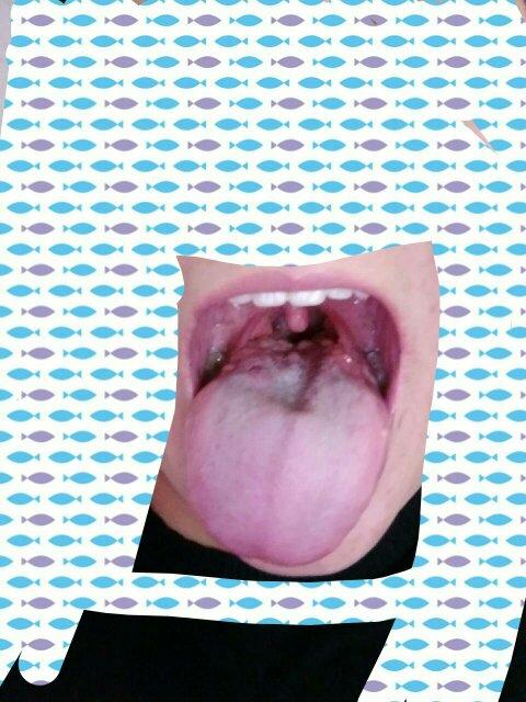 本人女,30岁,舌头根部长了好多疙瘩,好几个月了,不疼不痒