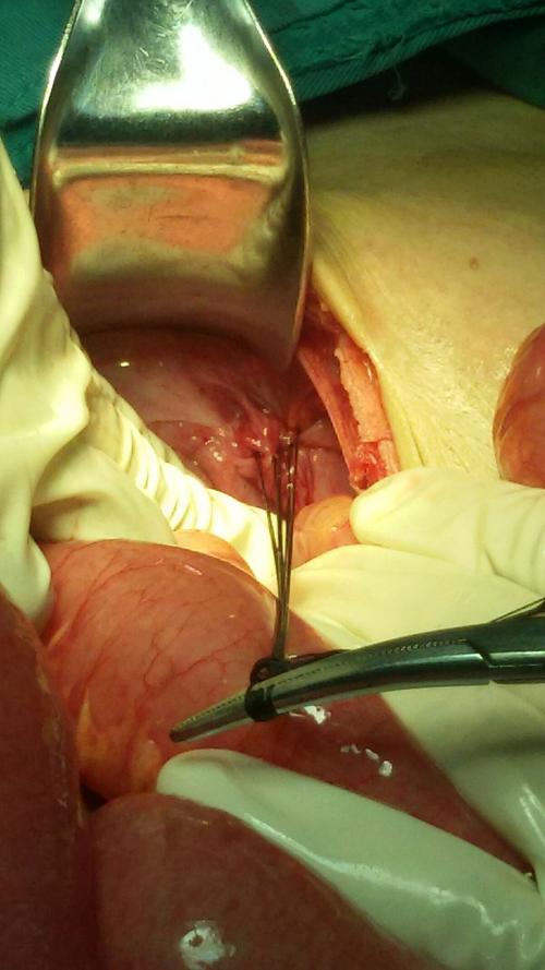 闭孔疝并嵌顿的早期诊断